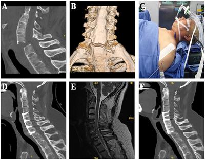 Treatment of lower cervical spine fracture with ankylosing spondylitis by simple long anterior cervical plate: a retrospective study of 17 cases